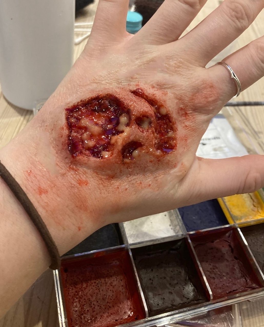Open Wound on Hand