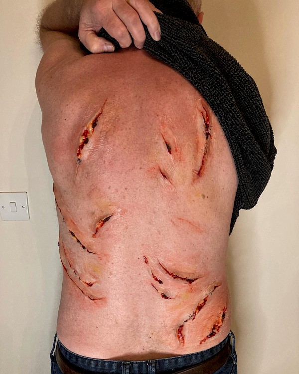 Animal Attack Scars