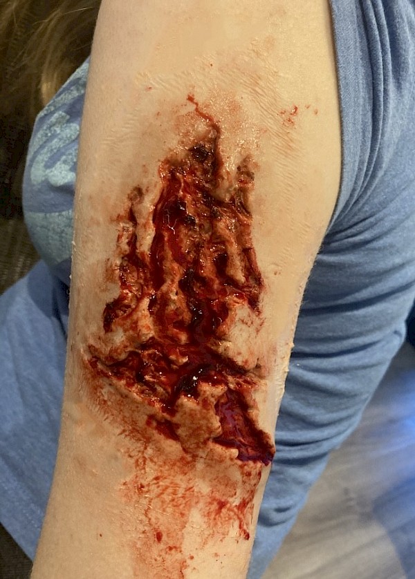 Gory Injury on Arm