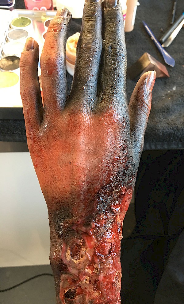 Burnt Arm/Hand